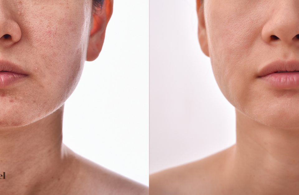 a before and after image of a woman who had a skin rejuvenation procedure (model)