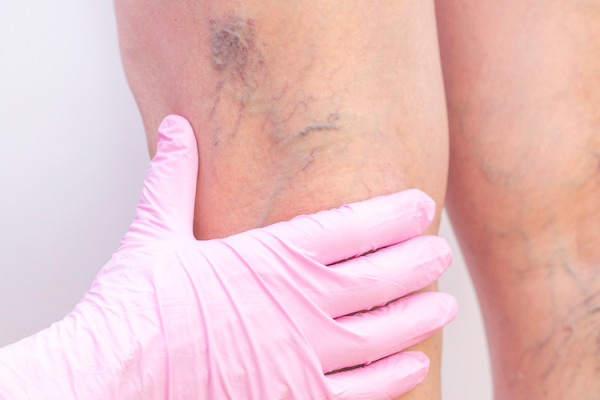 sclerotherapy-london-ontario-dermatology- (7)